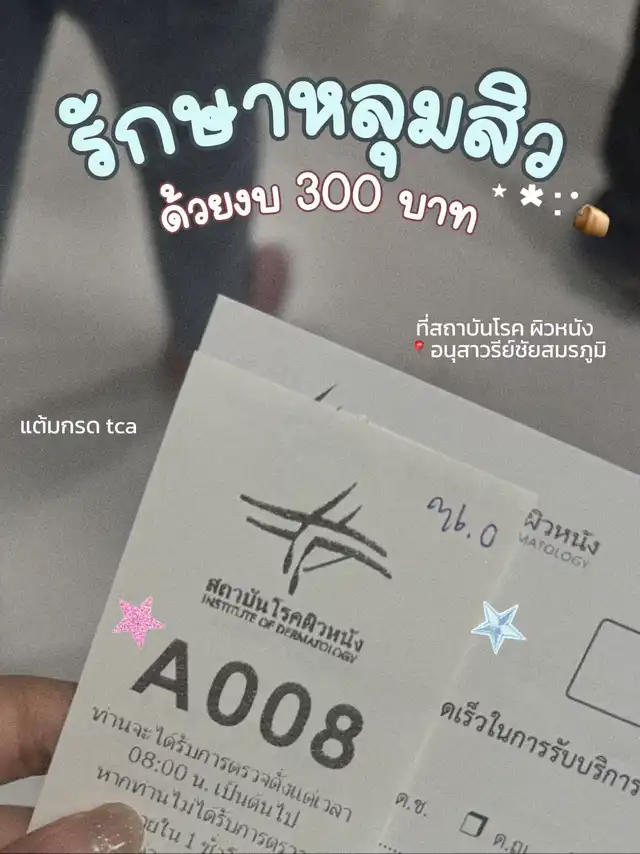 ตั๋วคิว A008 จากสถาบันโรคผิวหนัง อนุสาวรีย์ชัยสมรภูมิ สำหรับการรักษาหลุมสิวด้วยการแต้มกรด TCA ในงบประมาณ 300 บาท